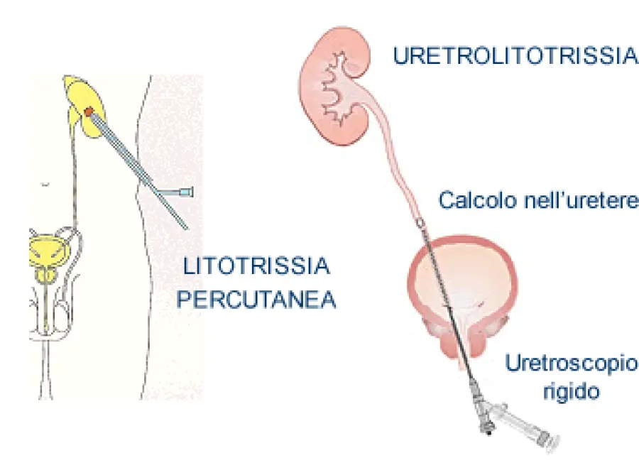 Uso del laser in urologia a Lecco