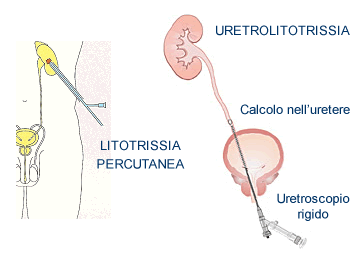 Uso del laser in urologia a Lecco