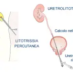 Uso del laser in urologia a Lecco